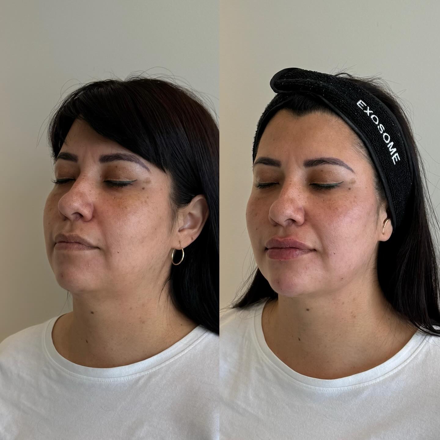 Armonización — Vista en Ángulo