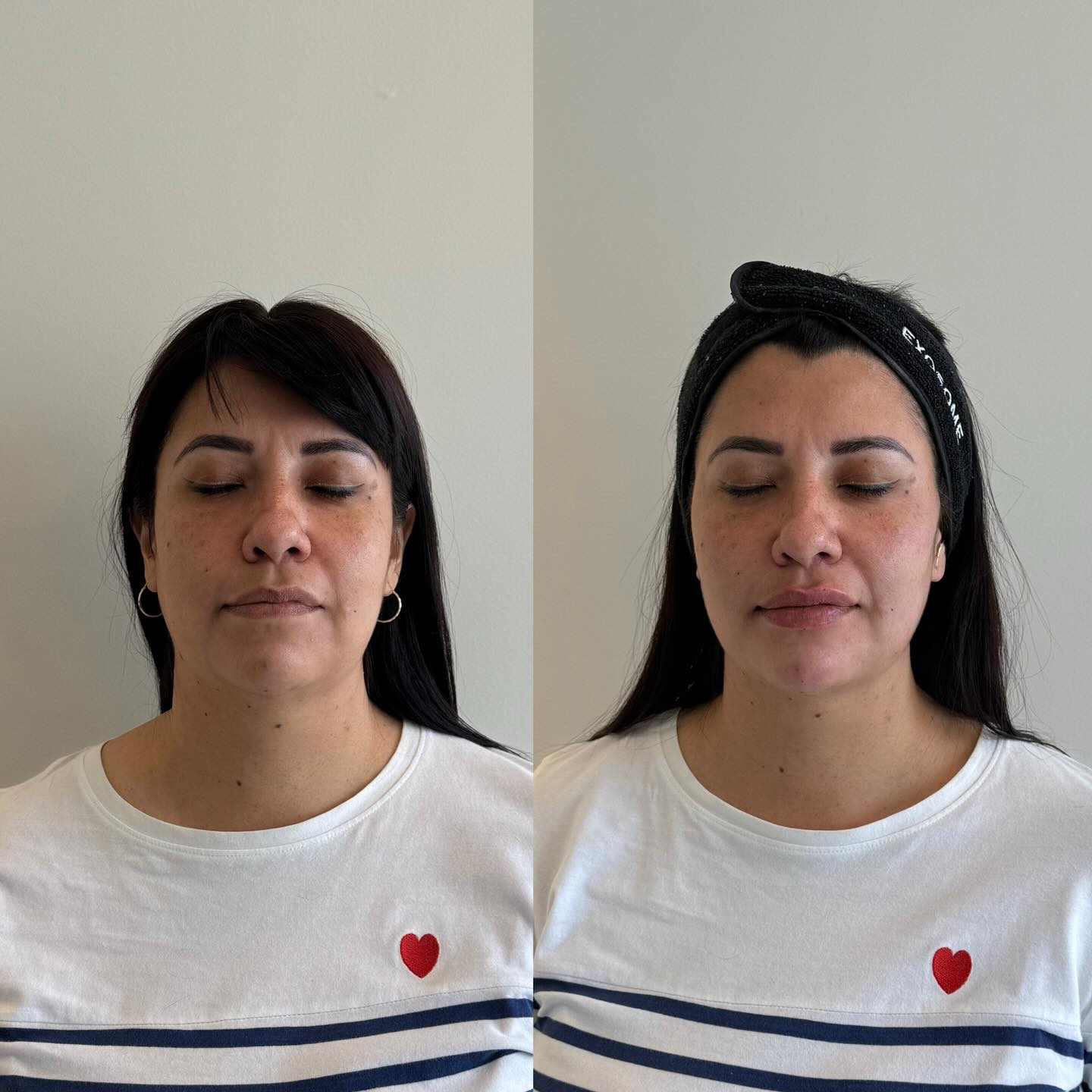 Armonización Facial
