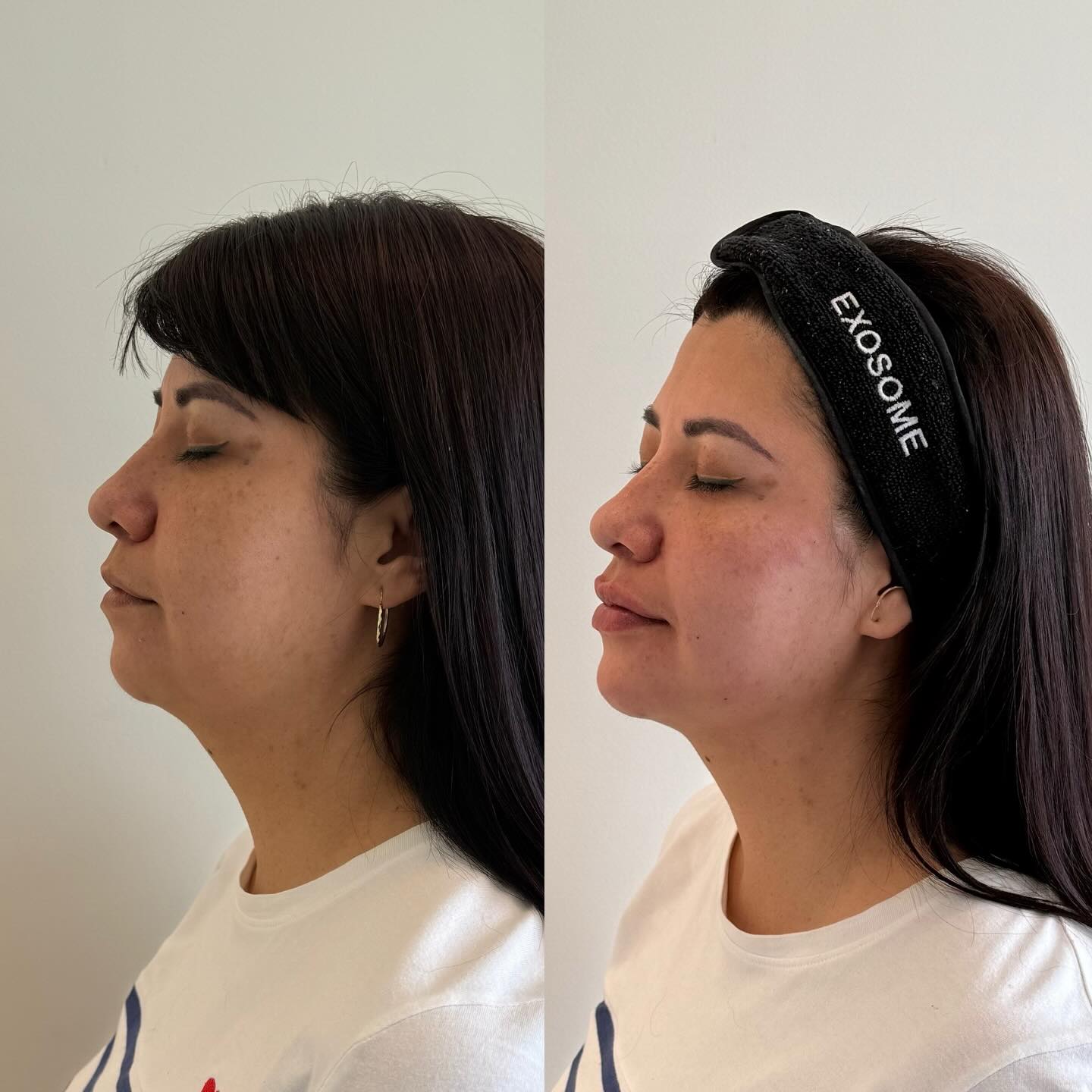 Armonización — Vista de Perfil