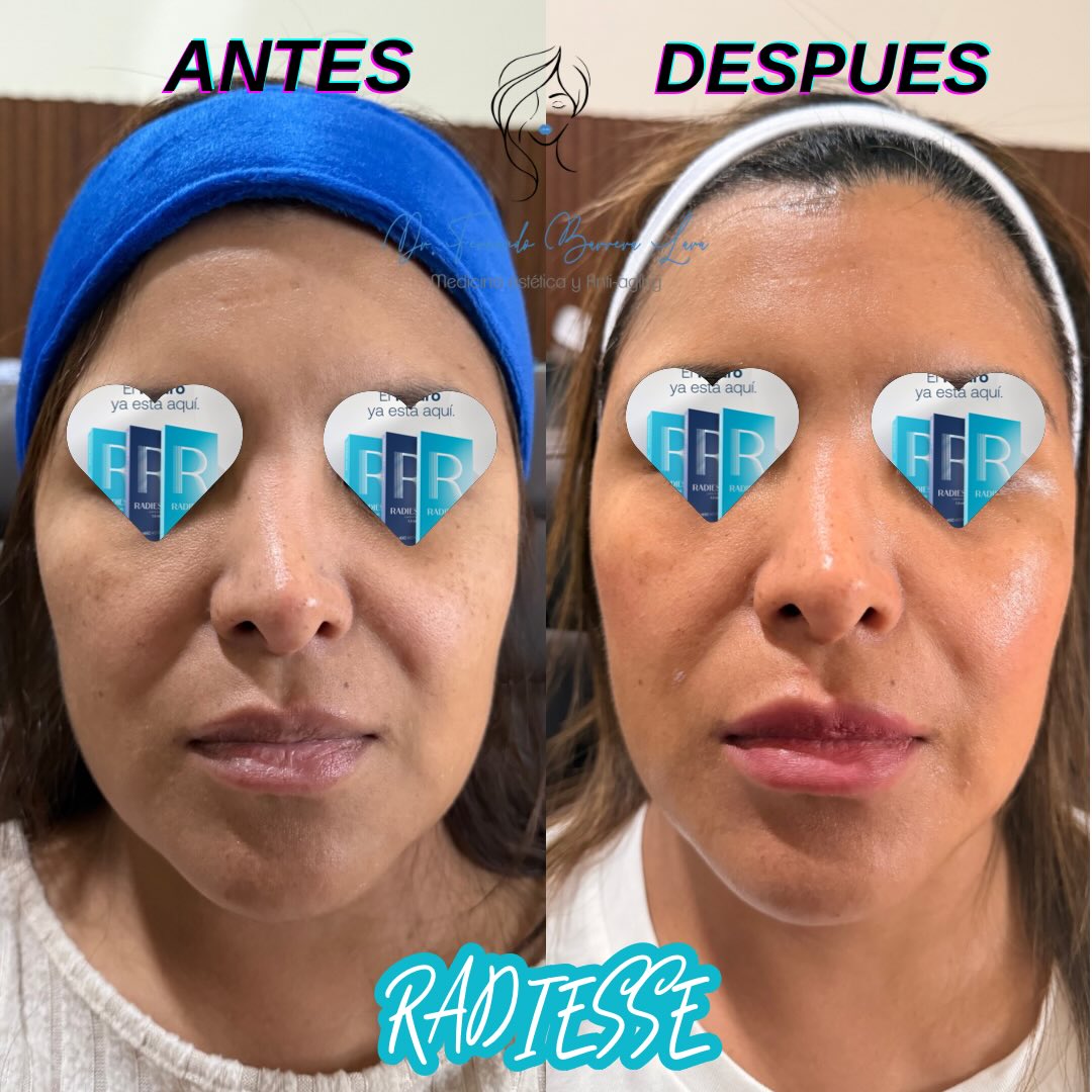 Bioestimulación + Perfilado de Labios