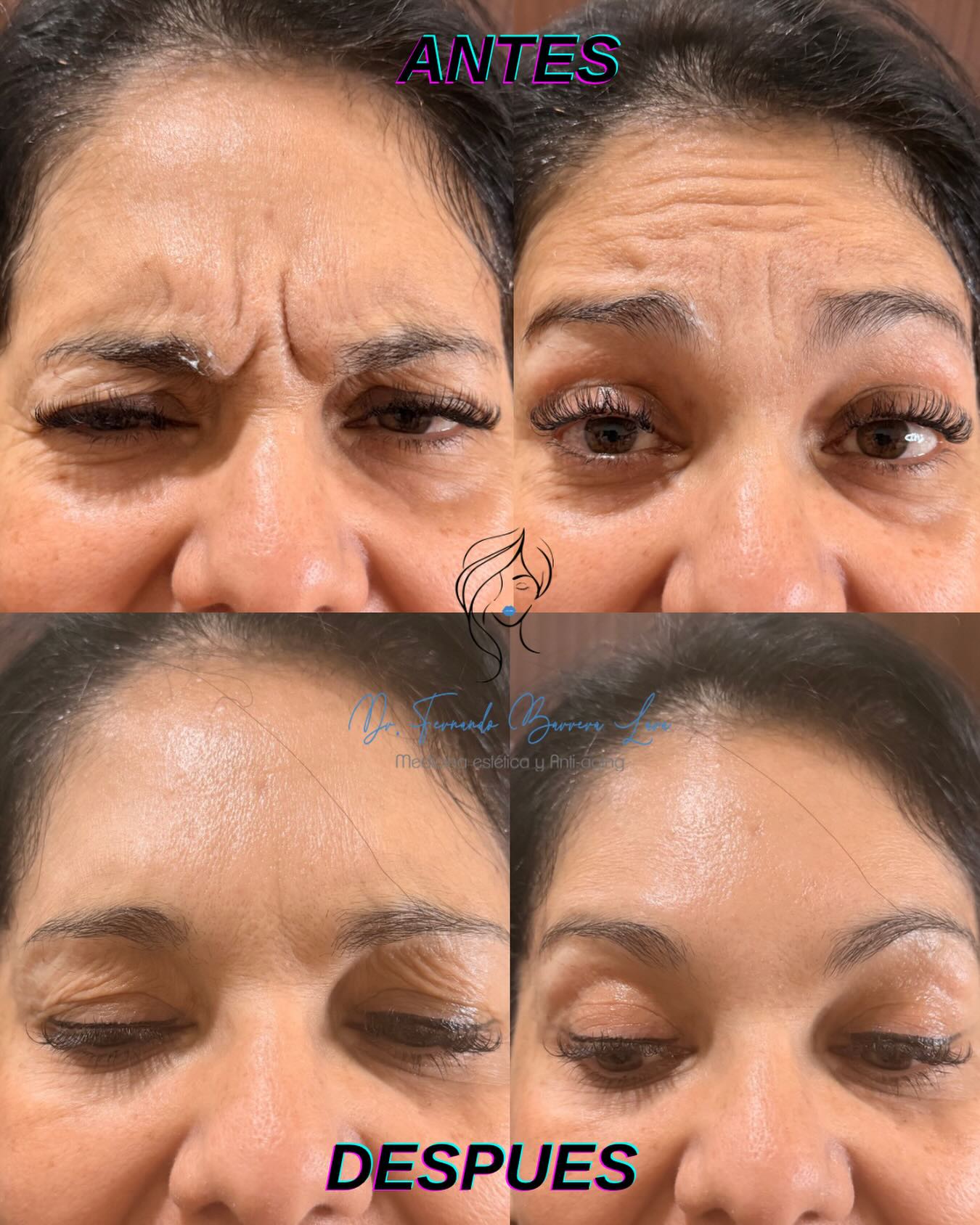 Aplicación de Botox