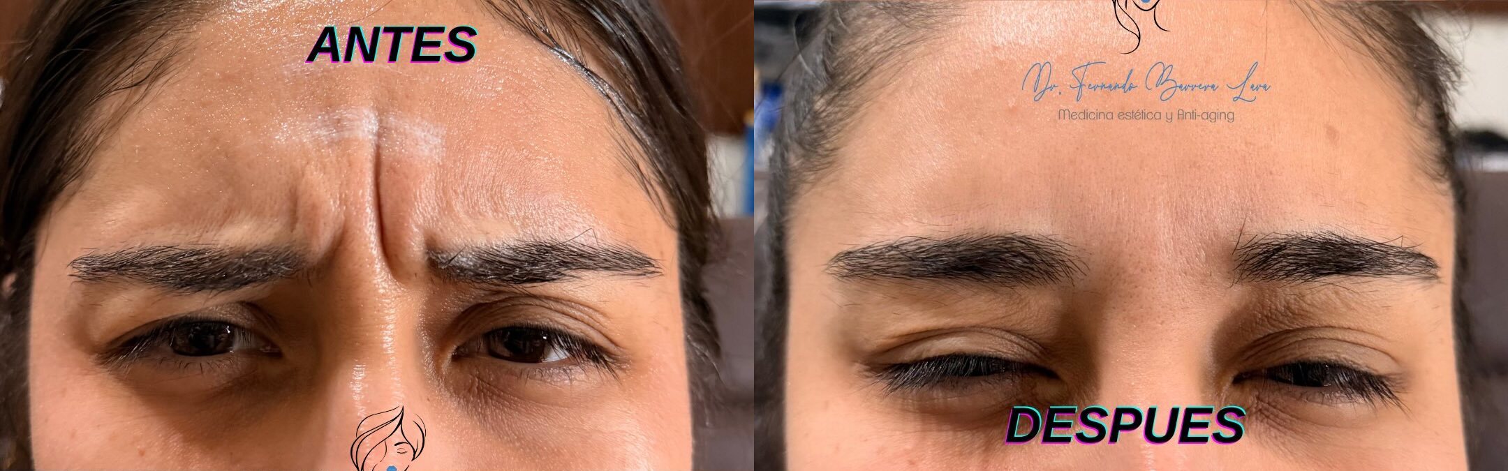 Botox — Resultados Naturales
