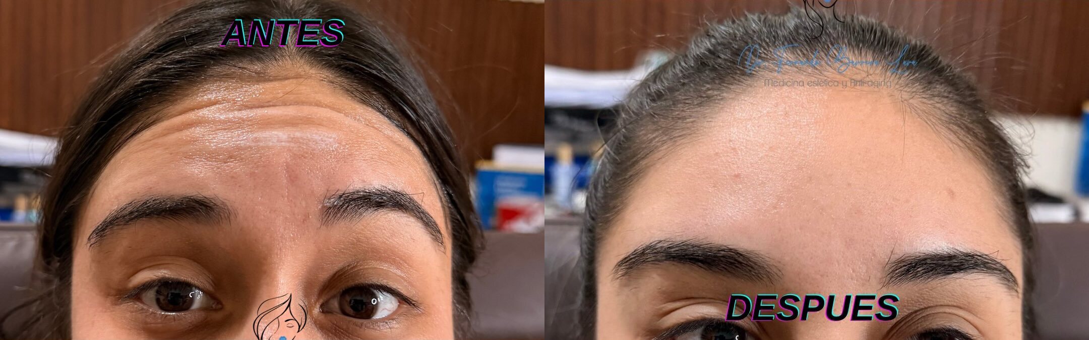 Botox — Zona de Antifaz