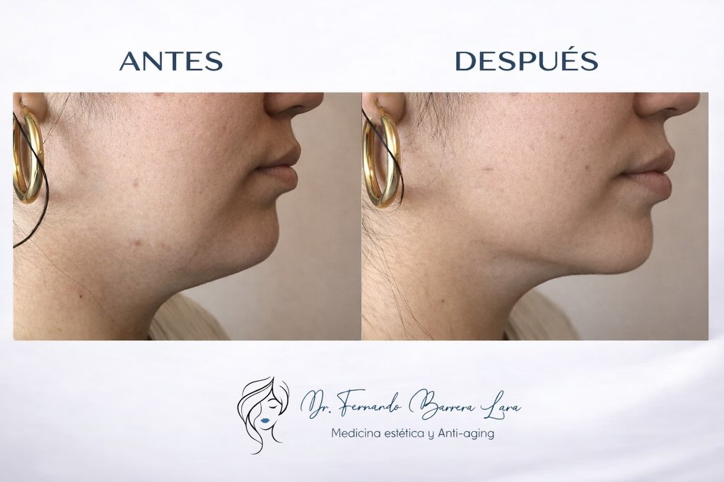 Tratamiento de Papada