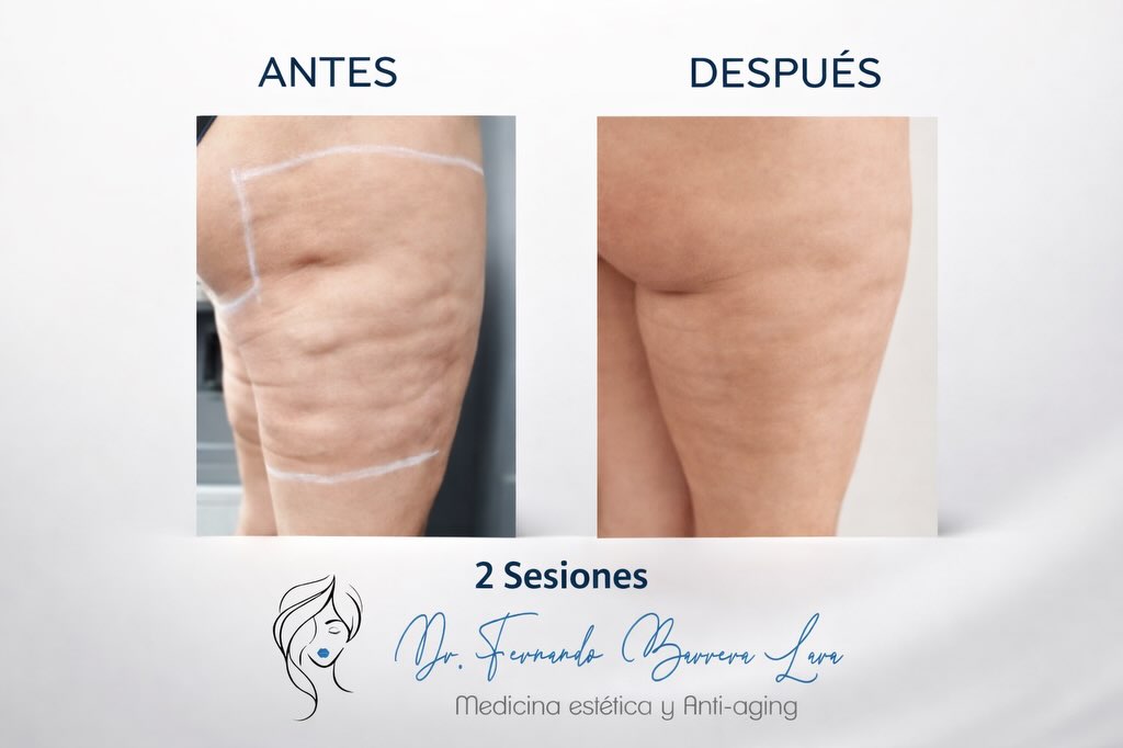 Reducción de Grasa Corporal