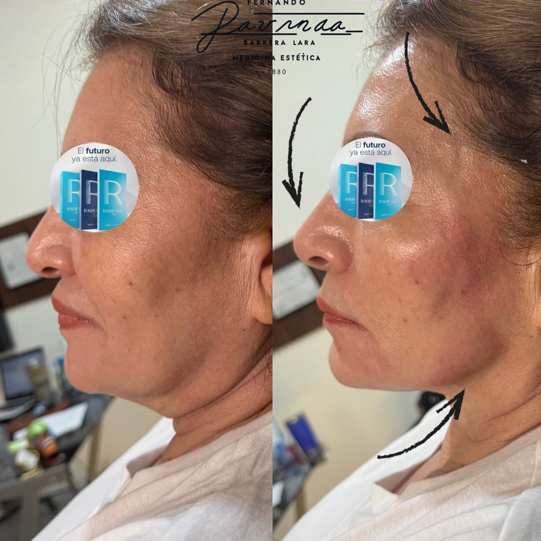 Radiesse — Antes y Después