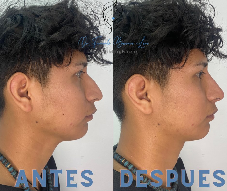 Rinoremodelación — Caso 2