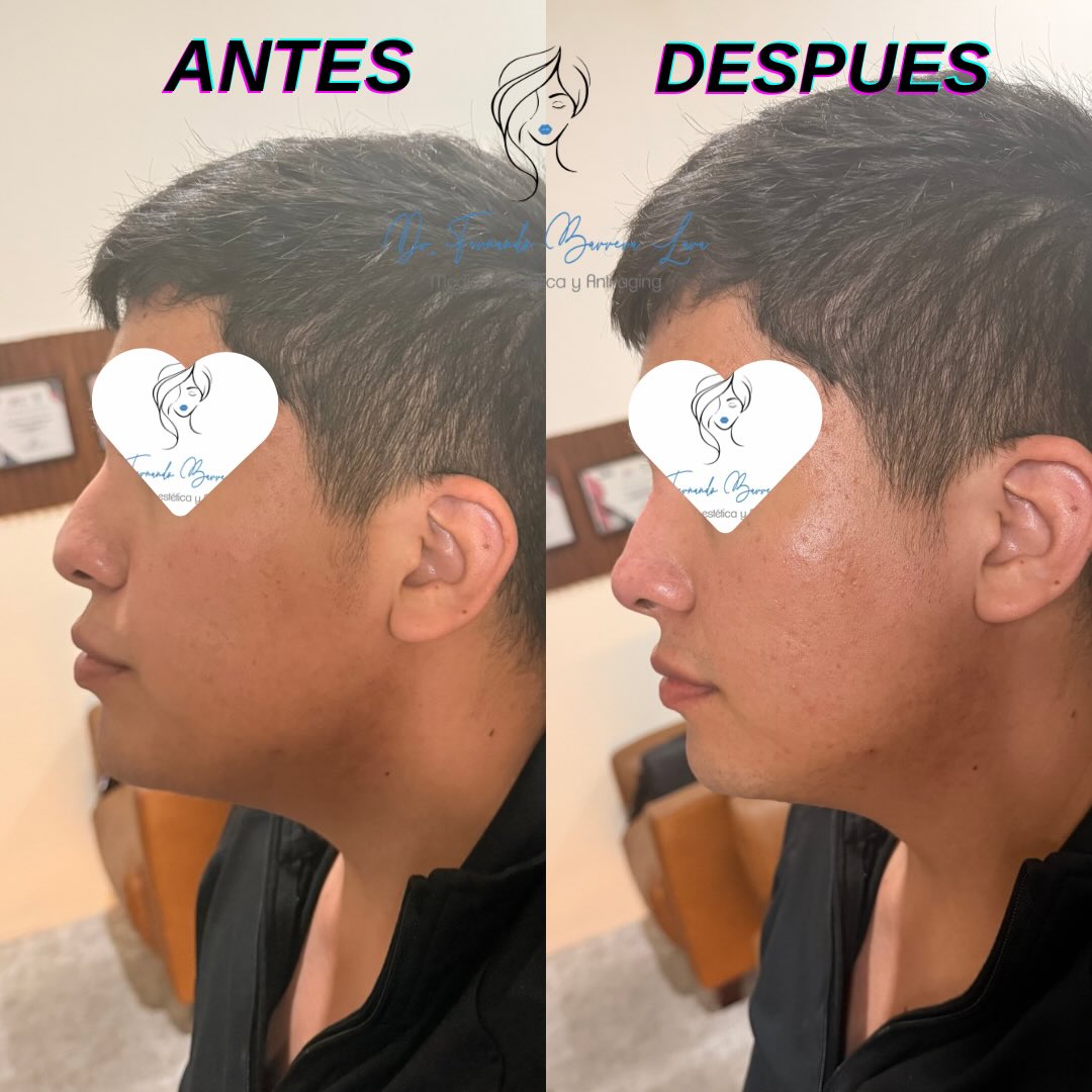 Rinoremodelación sin Cirugía